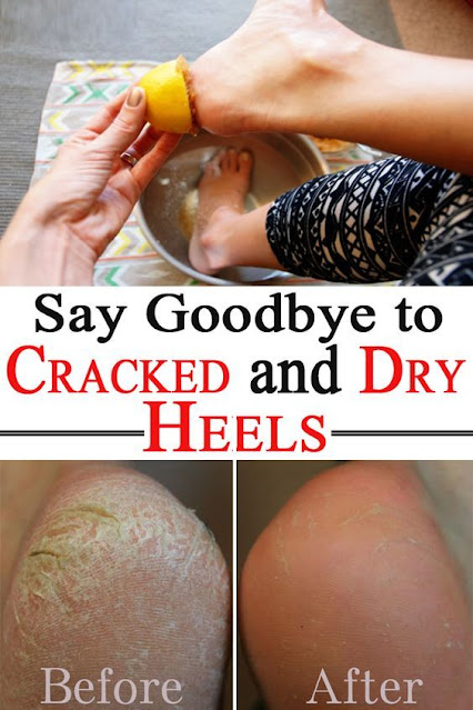Say Goodbye to Cracked and Dry Heels
