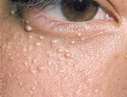 Understanding Milia: Causes, Treatment, and Prevention