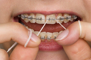 Phương pháp niềng răng không nhổ răng-1