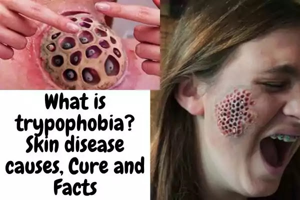 Trypophobia skin disease
