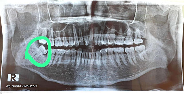 Gigi impaksiku difoto dengan foto rontgen panoramic