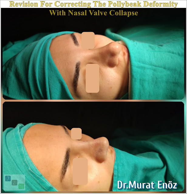 Nasal valve collapse, Pollybeak Deformity, Polly Beak Nose Deformity,