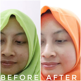 skincare untuk menghilangkan noda hitam di wajah