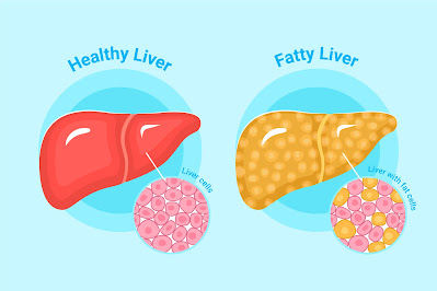 Motaape Aur Sambandhit Sthitiyon, Jaise Vasaayukt Yakrt Rog(Fatty Liver) Ke Jokhim Ko Kam Karane Ke Lie Subah Kee Sair