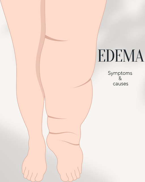 Edema Symptoms & causes