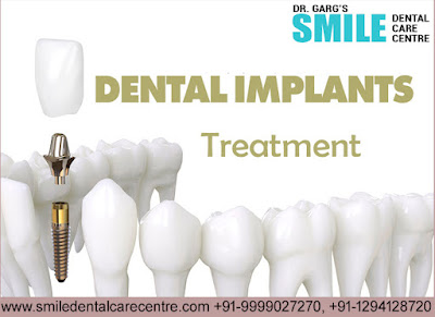 Best Dental Implant Clinic in Faridabad