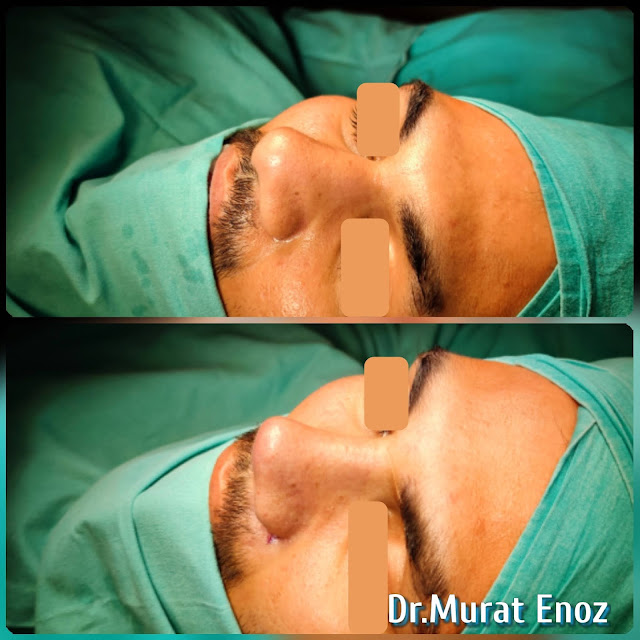 Natural nose aesthetic surgery for male,Male thick skinned rhinoplasty,Ethnic expert rhinoplasty surgeon,Ethnic Rhinoplasty in Istanbul,