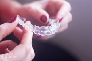 Invisalign là gì-2