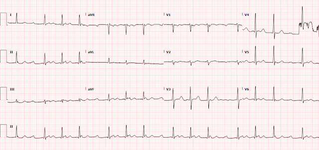 A man in his 60s with a seemingly mechanical fall and subsequent seizure. Until the ECG.