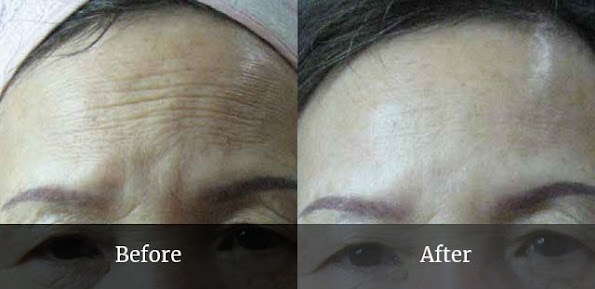 IPL treatment London