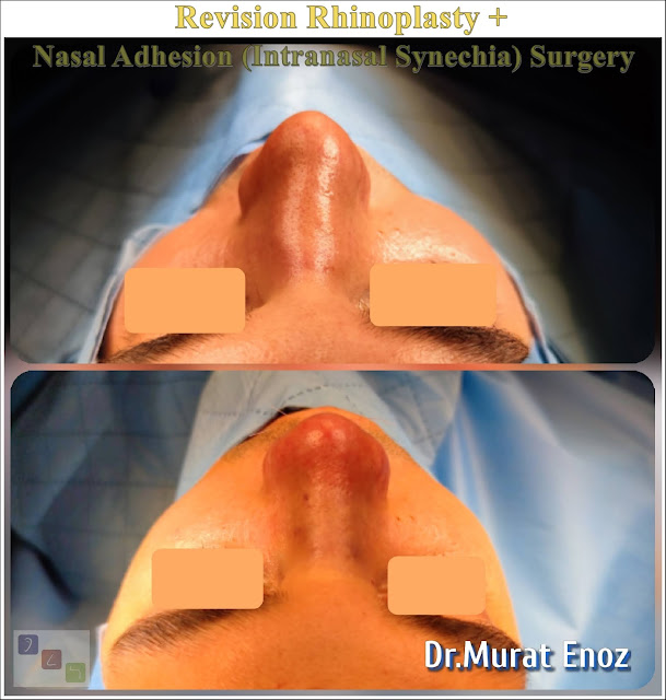 revision rhinoplasty + nasal adhesion removal surgery + septoplasty + nasal bone spur excision