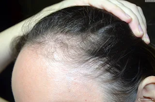 الهرمون المسؤول عن تساقط الشعر عند النساء