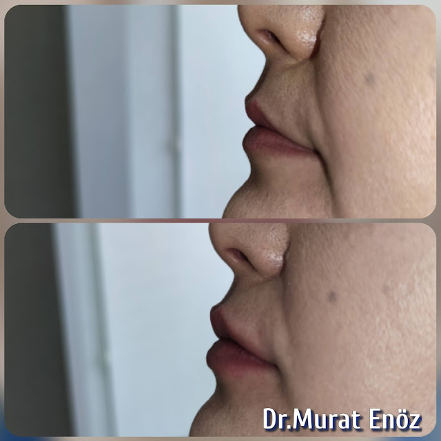 Lip Filler Injection - Augmentation in Istanbul