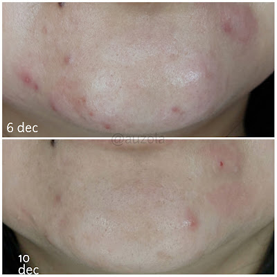 rivera-acne-&-dark-spot-corrector-serum-result