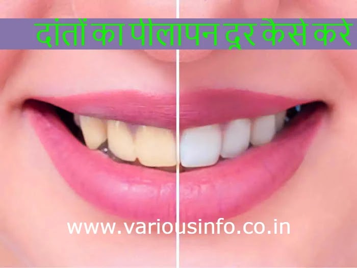 दांतों का पीलापन दूर कैसे करे (Remove yellowing of teeth )- Hindi various info