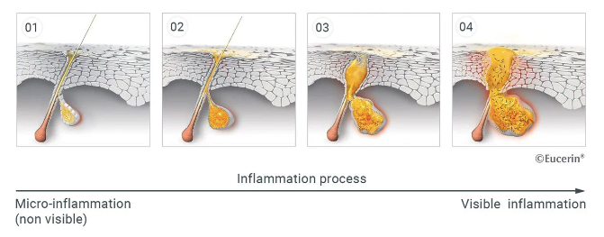 Illustration showing formation of acne