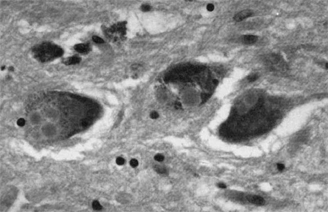 Lewy bodies on microscopy