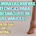 Tratamiento de venas varicosas con remedios caseros. Cómo curar las varices en casa