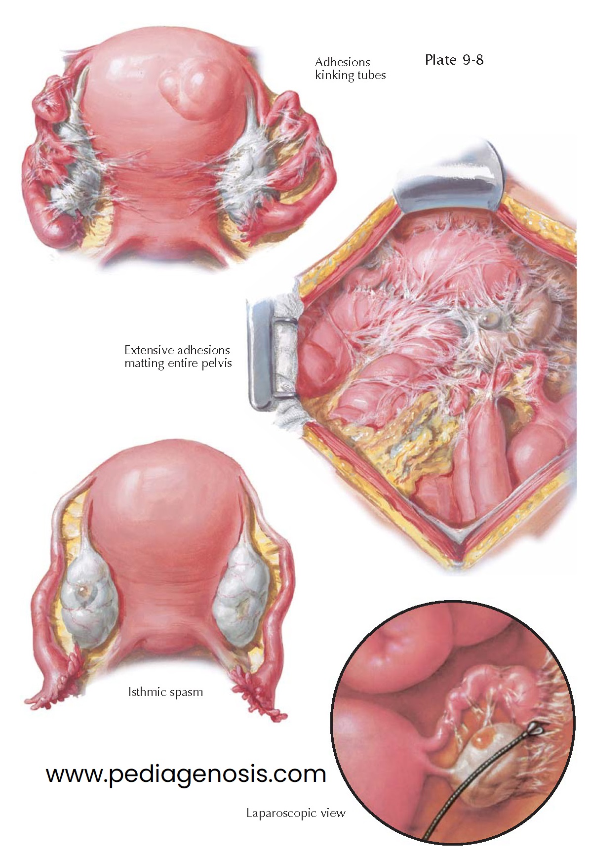 CHRONIC SALPINGITIS, ADHESIONS