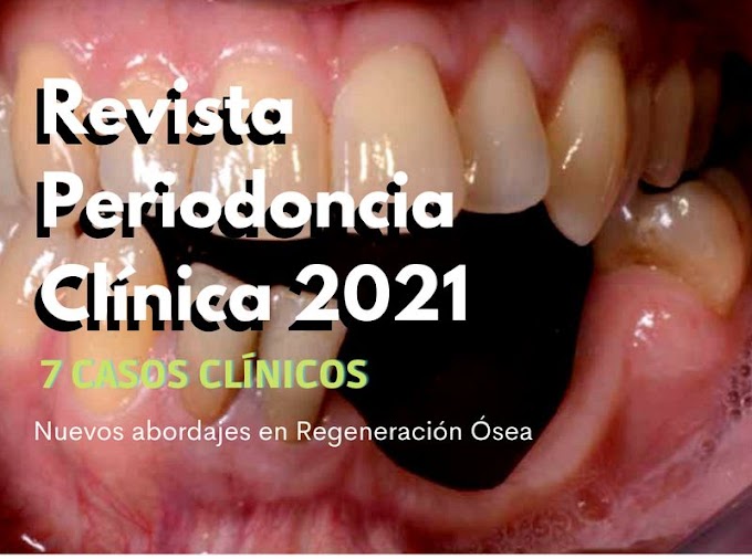 PDF: Nuevos abordajes en Regeneración Ósea - 7 Casos Clínicos - Revista Periodoncia Clínica 2021
