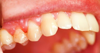 Có nên nhổ răng bị viêm chân răng lâu ngày?-2
