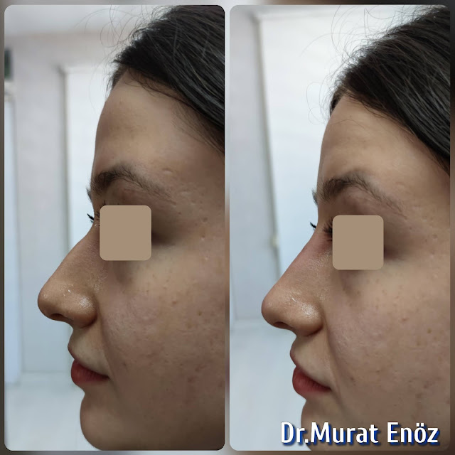 5 Minutes Nose Job With Filler in Istanbul, Non surgical liquid rhinoplasty