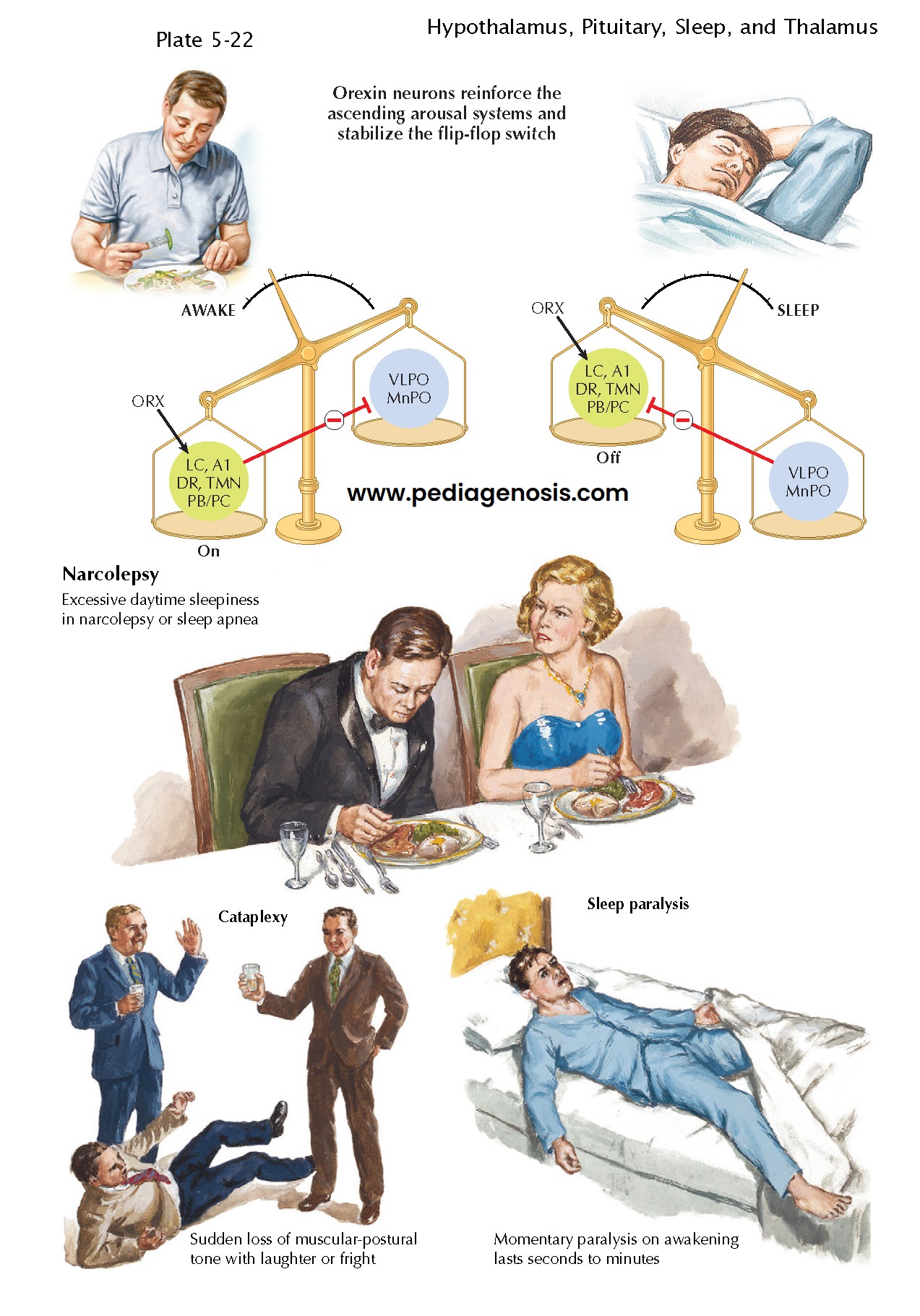 Narcolepsy: A Hypothalamic Sleep Disorder