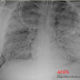 ARDS Nedir?