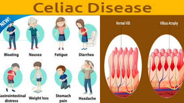 celiac disease symptoms,searches, Celiac disease symptoms in females, Celiac disease treatment, Celiac disease symptoms adults, Celiac disease diet, Celiac disease meaning, Celiac disease symptoms checklist, Celiac disease foods to avoid,Celiac disease symptoms in