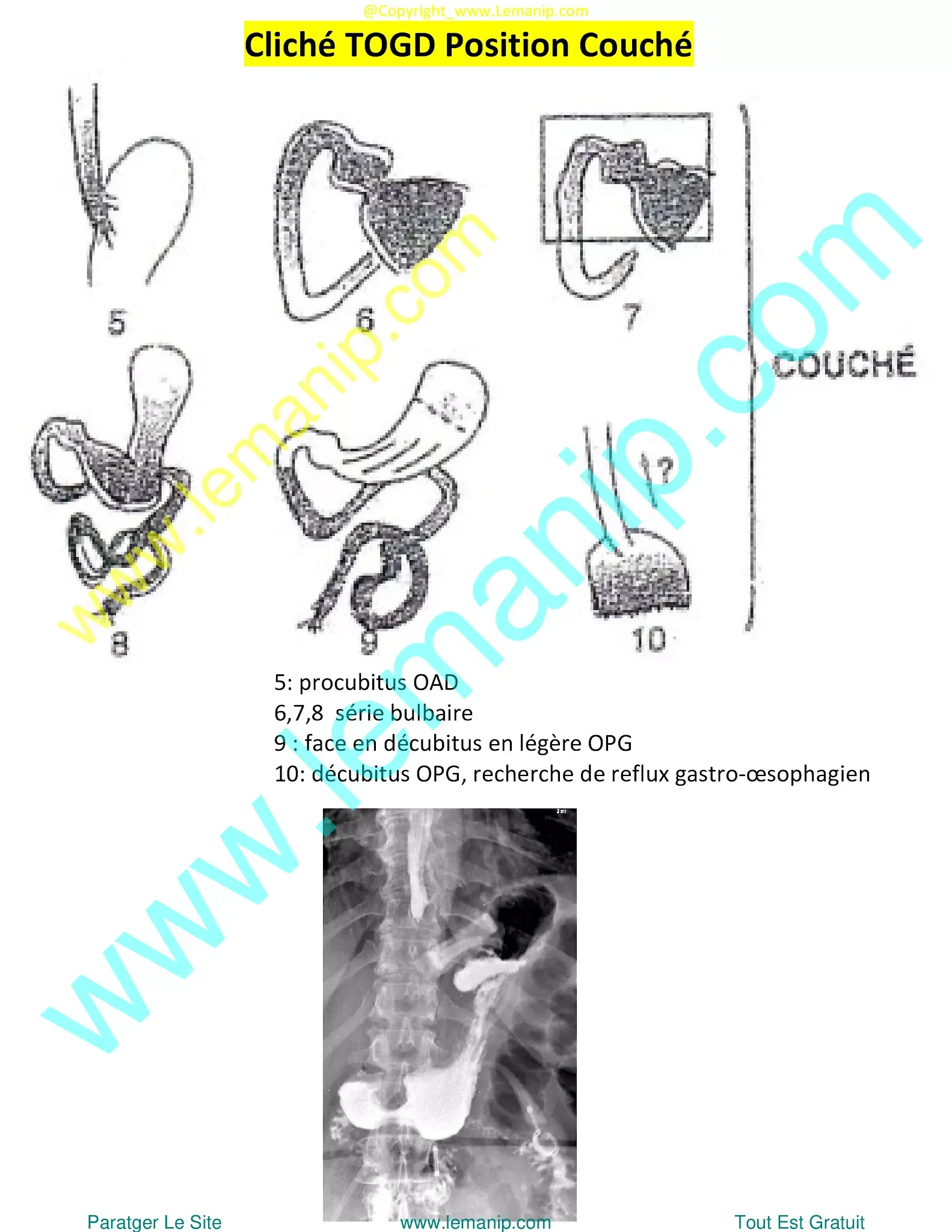 eosinophilic esophagitis symptoms in adults,ee esophagus,esophagitis endoscopy,the gastro group,dr rubin gastro,dr gold gastro,vanguard gastro,gj gastro,duodenal neuroendocrine tumor,esophageal esophagitis