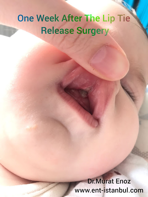 Lip Tie Release Surgery One Week After