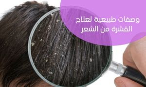 وصفات طبيعية لعلاج القشرة من الشعر