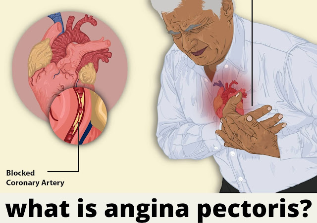 what is angina pectoris -  Angina Symptoms, causes And angina attack what to do?