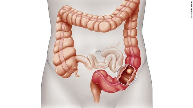 What are the Treatment Options for Colon Cancer
