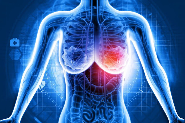 New Study Reveals Recurrent Node-Positive Breast Cancer Patients Develop Distant Metastasis