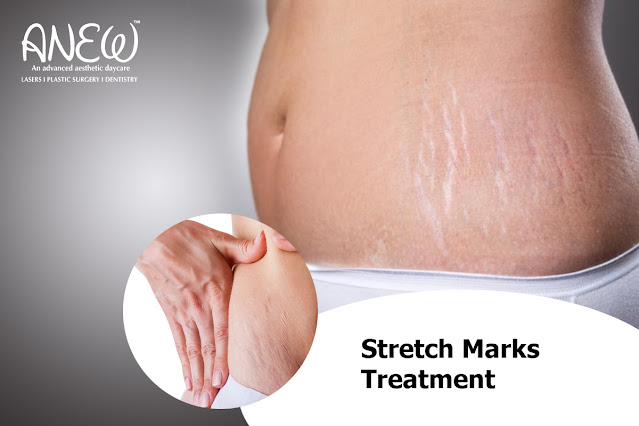 Streach Mark Treatment in Bangalore