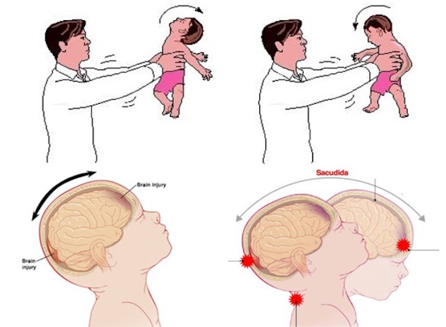  El síndrome del bebé sacudido