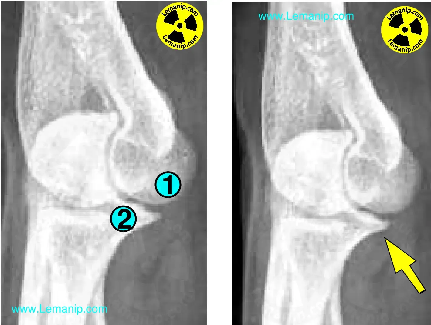 Cliché Rx Processus coronoïde Incidence en Extension + Radio Anatomie