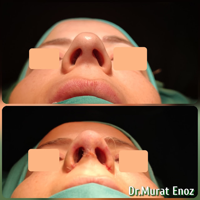 nose job,Natural rhinoplasty in Istanbul,Natural looking nasal aesthetic surgery,nose reshaping,