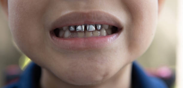 Kids with silver teeth