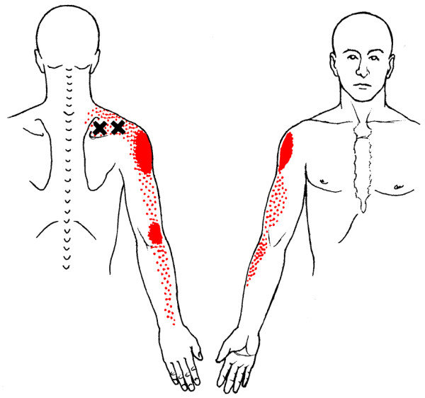 Referred Pain in Shoulder