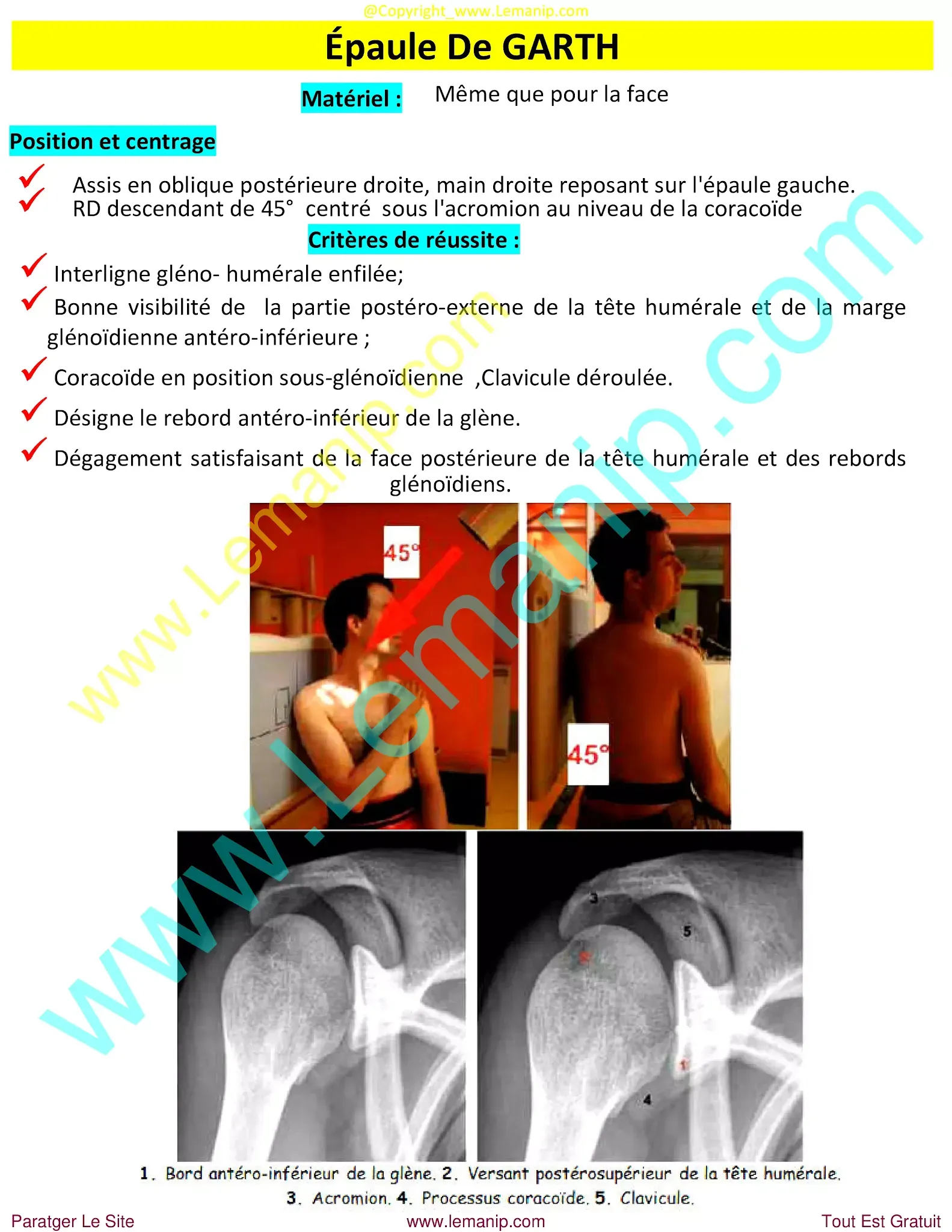 clavicle fracture at birth,broken collarbone at birth,shoulder and knee doctor,newborn clavicle fracture,newborn broken clavicle,infant clavicle fracture,broken clavicle at birth,newborn broken collarbone,infant broken clavicle,shoulder reliever