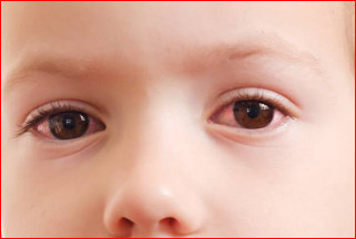 Pink Eye Symptoms in Babies