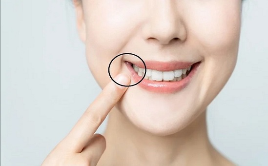 How To Home Remedies To Get Rid Cavities In Teeth  इन चार चीजों को लगाने से दांत में लगे कीड़े से मिलेगा जल्द छुटकारा