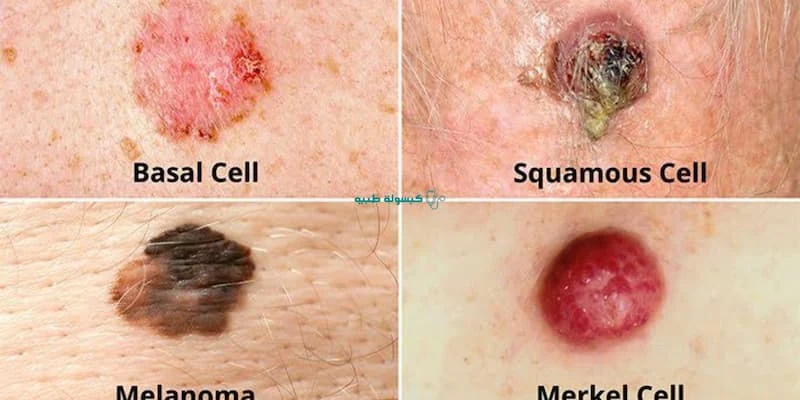 أنواع وصور سرطان الجلد بالصور