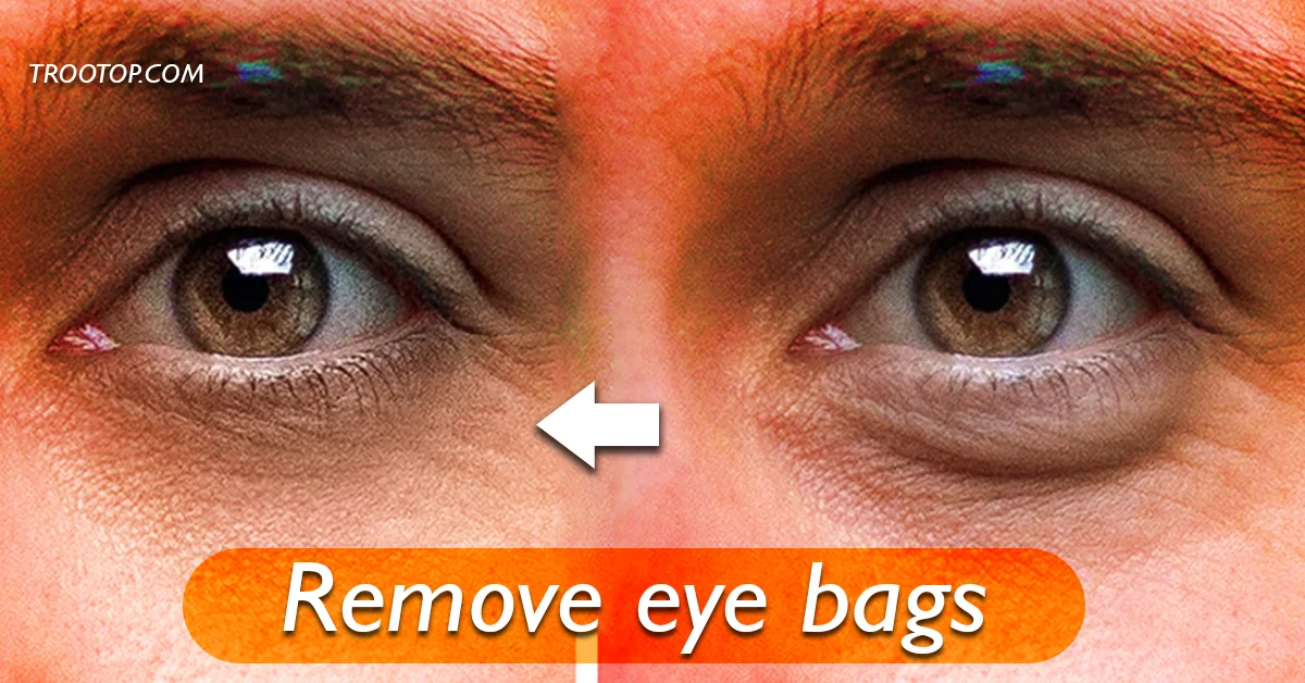 how to remove eye bags