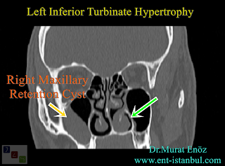 Turbinate hyopertrophy + The tomography image above shows a retention cyst in the right maxillary sinus and left inferior tubinate hypertrophy (yellow arrow). The patient has been receiving treatment for allergic rhinitis for a long time and has a complaint of nasal congestion.