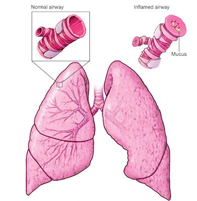 Asthma: Understanding the Causes, Symptoms, and Treatment