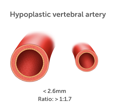 Гипоплазия позвоночной артерии может вызывать симптомы хронической ишемии в заднем отделе кровообращения головного мозга