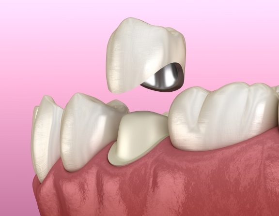 Phương pháp trồng răng sứ titan